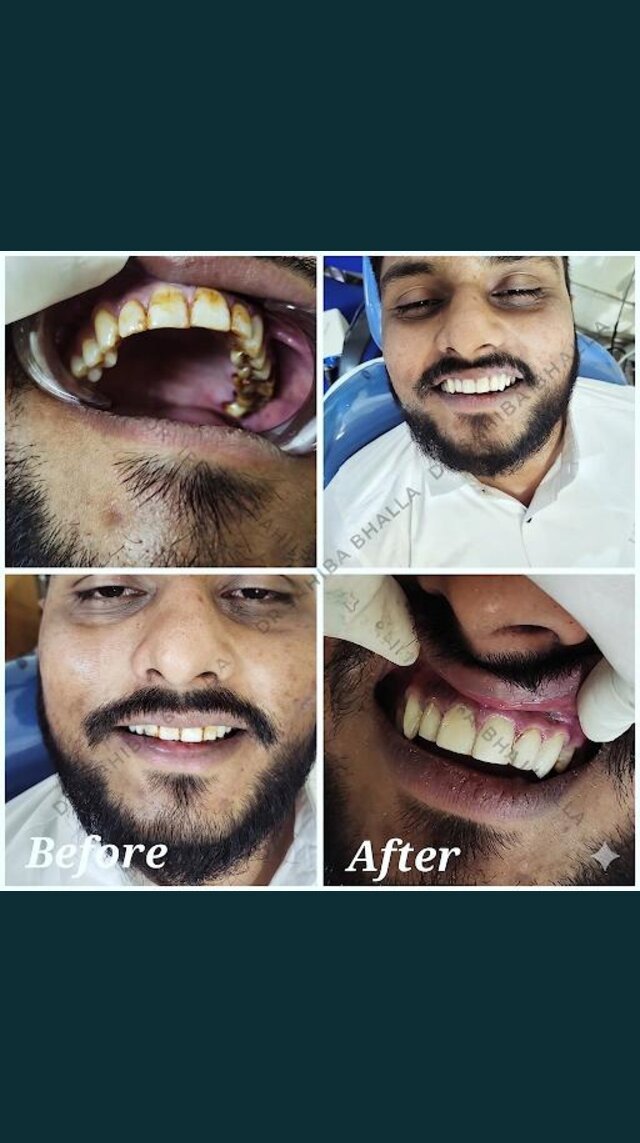 Adult smile makeover, before and after