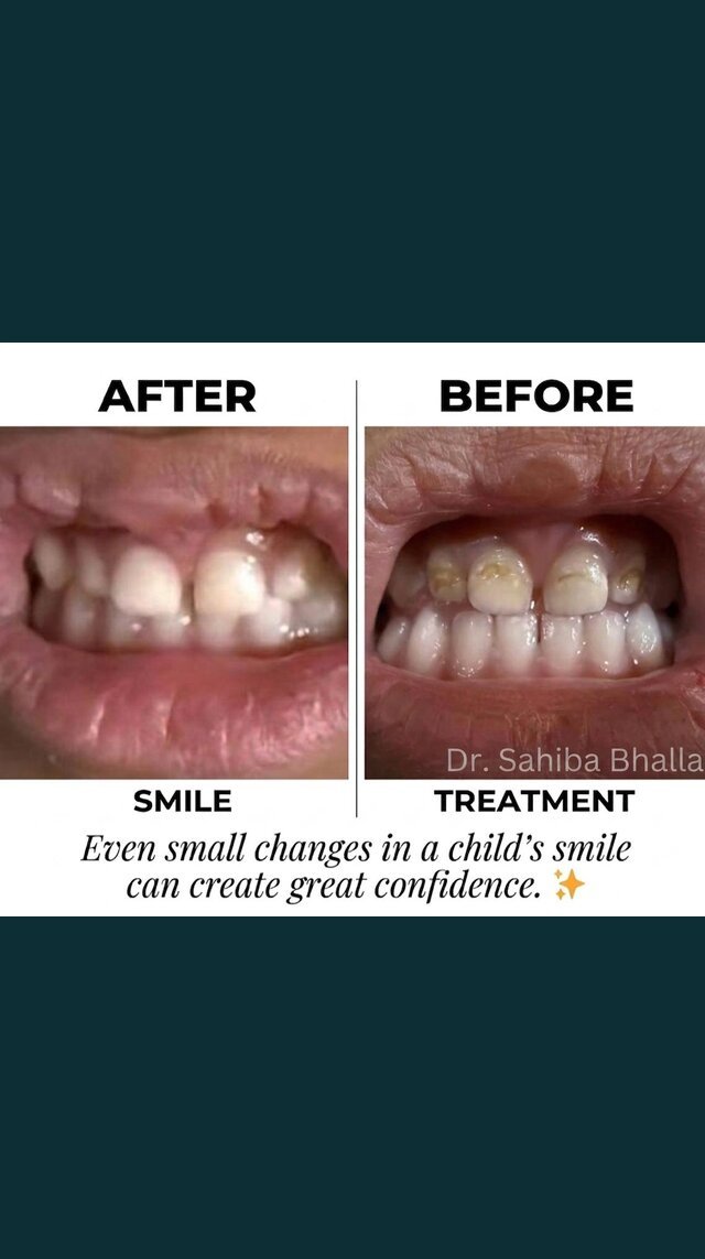 Before and after a child's smile treatment