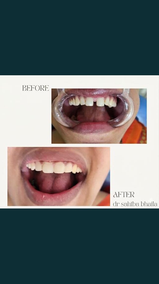 Gap closure between front teeth, before and after