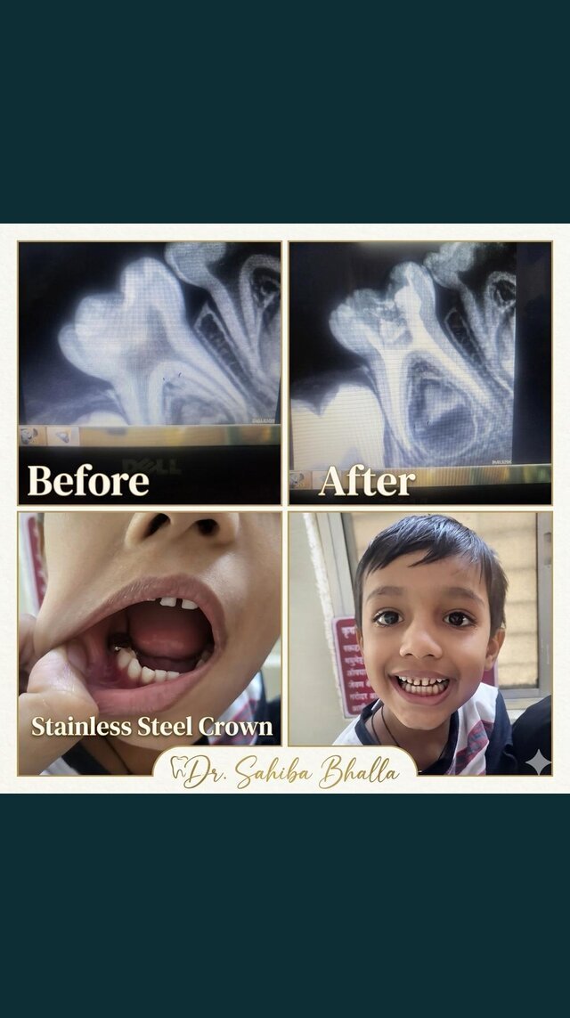 Pediatric root canal with stainless steel crown, before and after