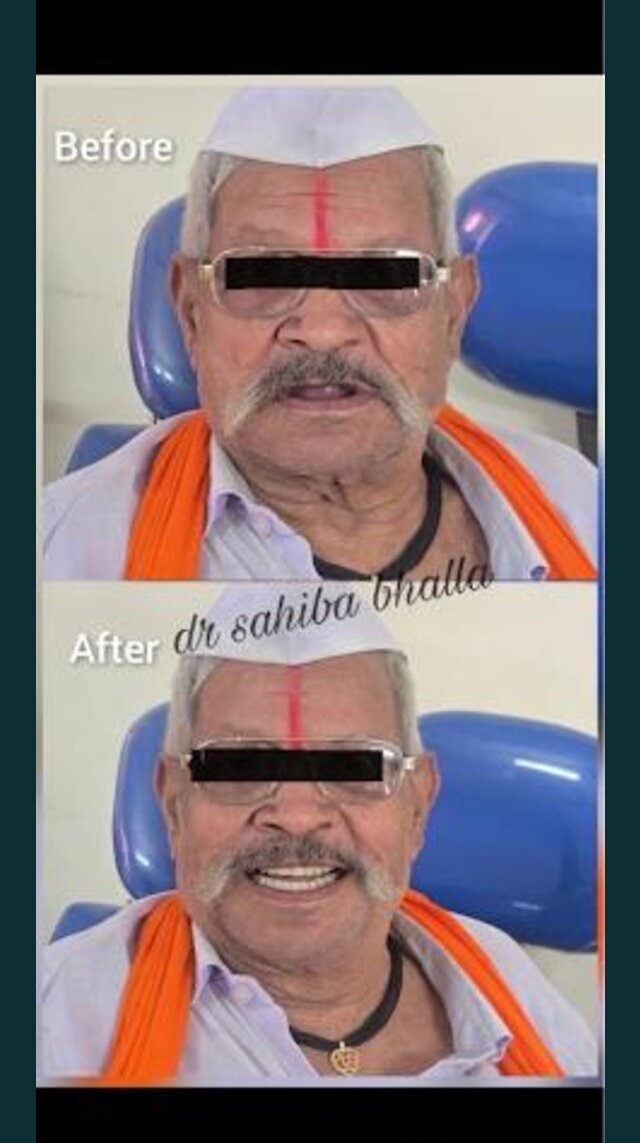 Senior patient smile restoration, before and after