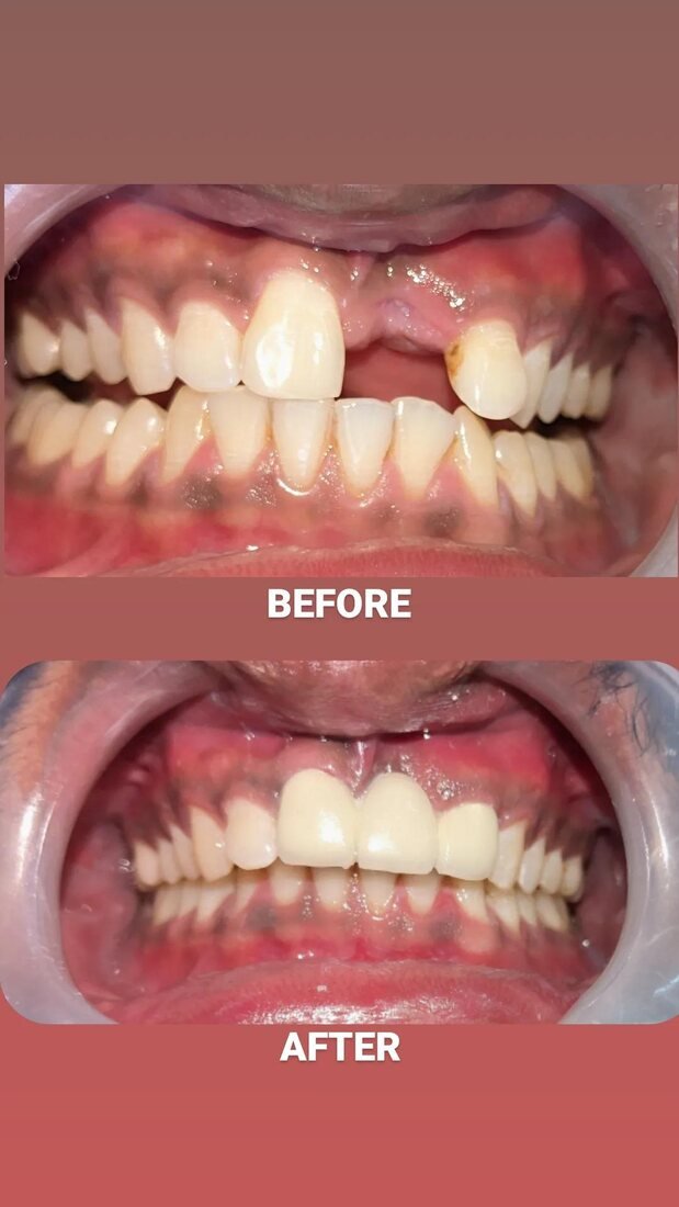 Before and after closing a gap between front teeth