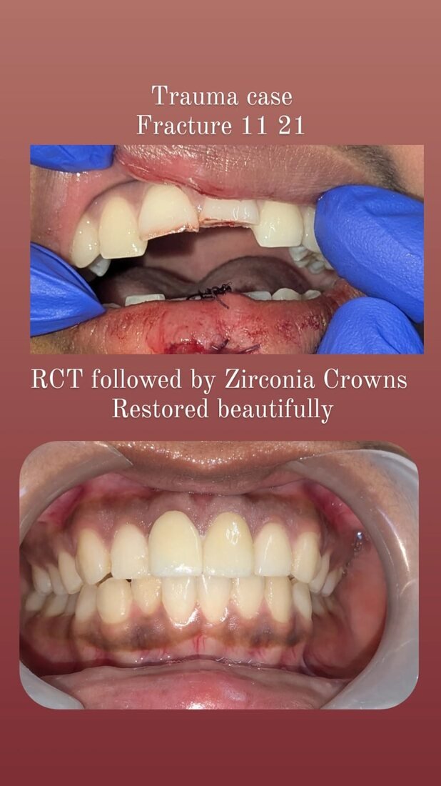 Trauma case restored with root canal treatment and zirconia crowns