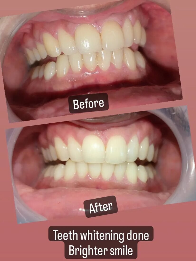 Before and after professional teeth whitening