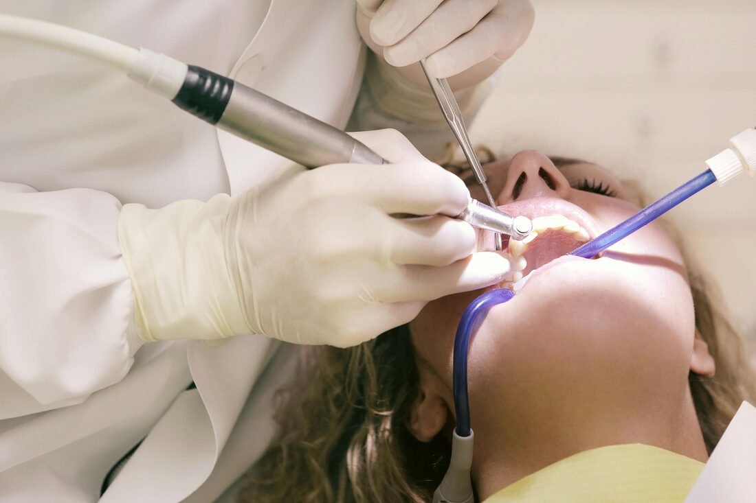 Fissure Sealants