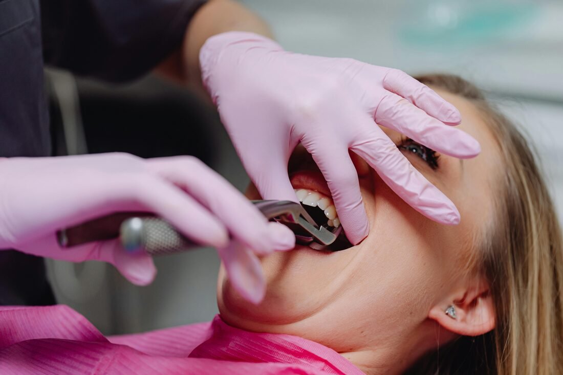 Wisdom Tooth Removal